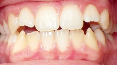 Before and After Gallery - Panther Creek Orthodontics