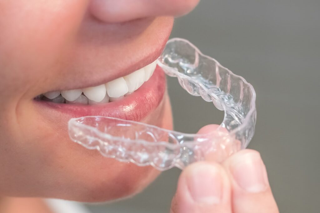 Invisalign at Panther Creek Orthodontics in The Woodlands, TX